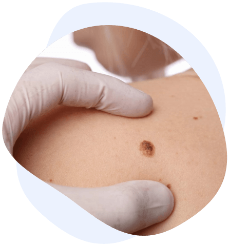 NewM Clinic provide the best mole removal treatments