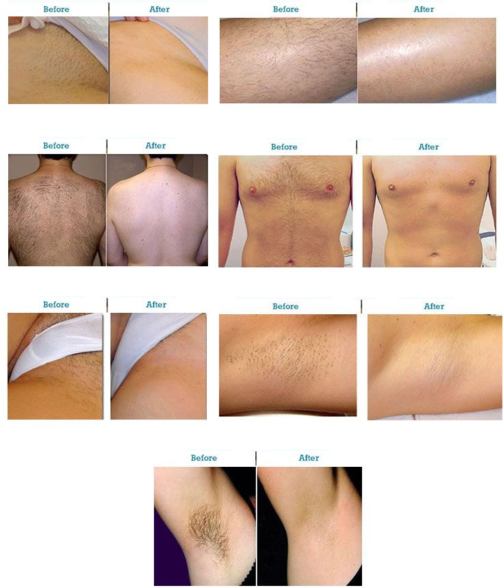 Laser Hair Removal before and After