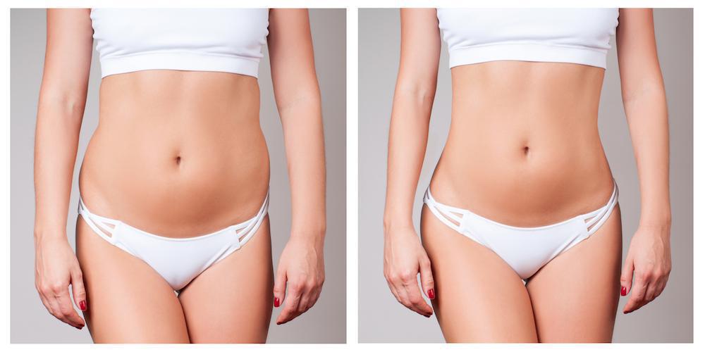 Body Contouring in Barrie