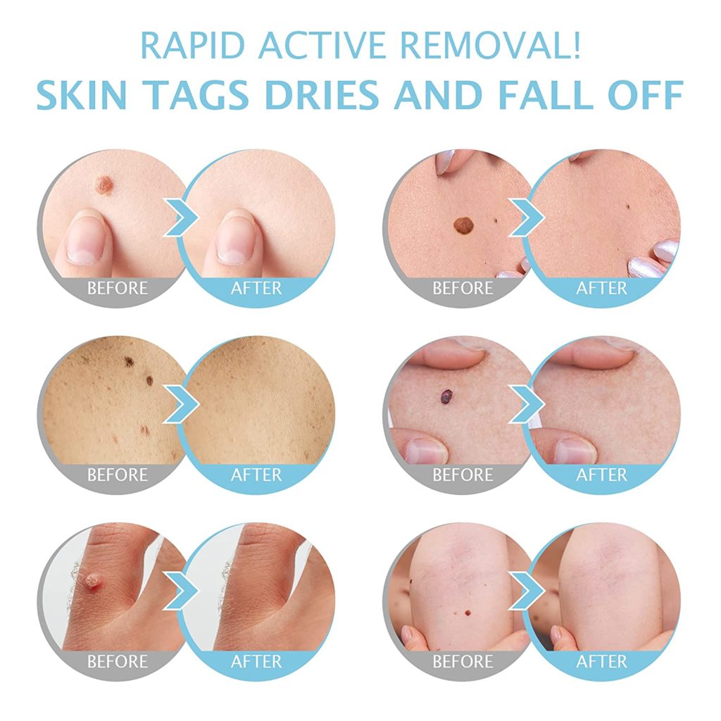Skin tag and mole remove